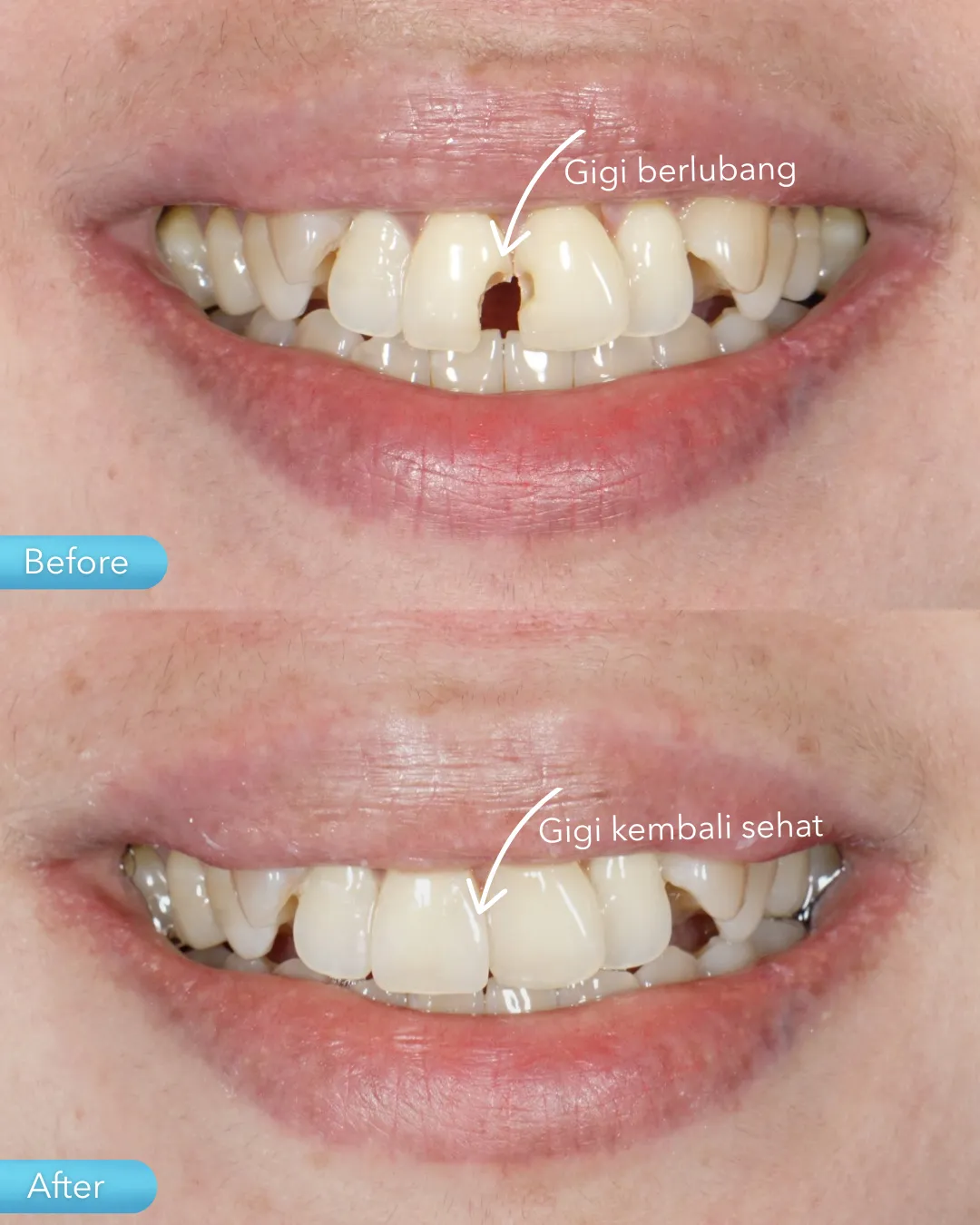 Dental filling result
